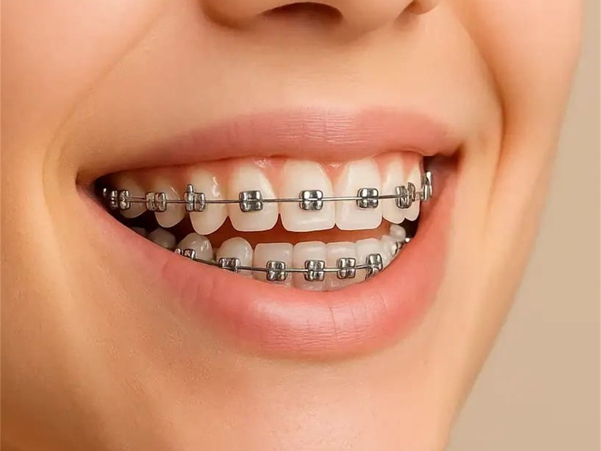 A close-up smile with fixed metal braces on the upper and lower teeth
