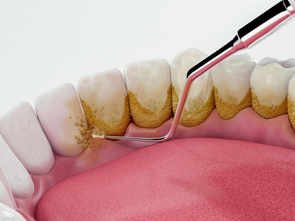 Hardened deposit being removed from the teeth at the gumline