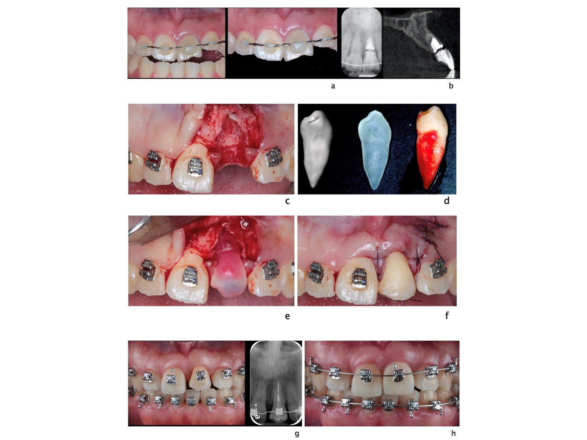 A clinical sequence showing an injured upper front tooth splinted, treated and realigned with braces