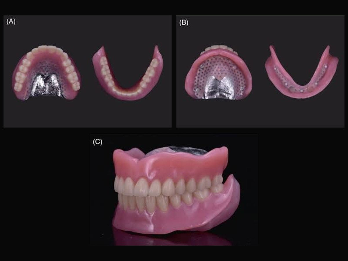 Implant-supported overdentures shown from the fitting surface and in the bite