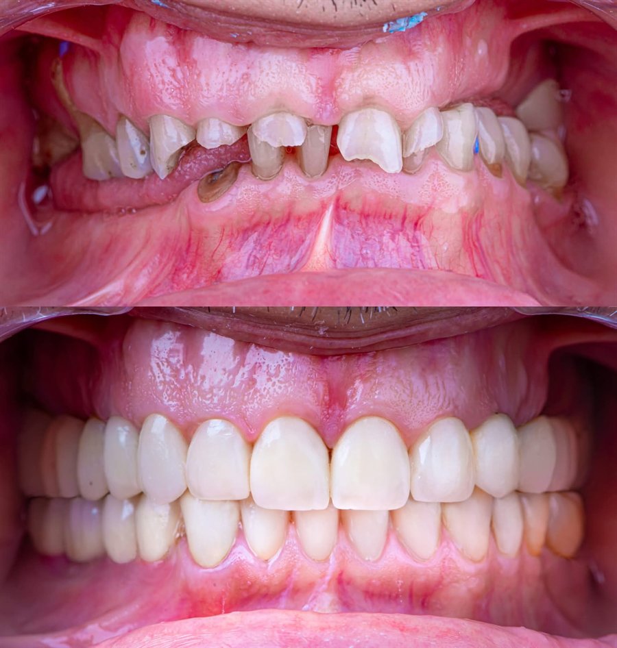 A full mouth rehabilitation case: worn and broken teeth before treatment, and the completed crowns afterwards