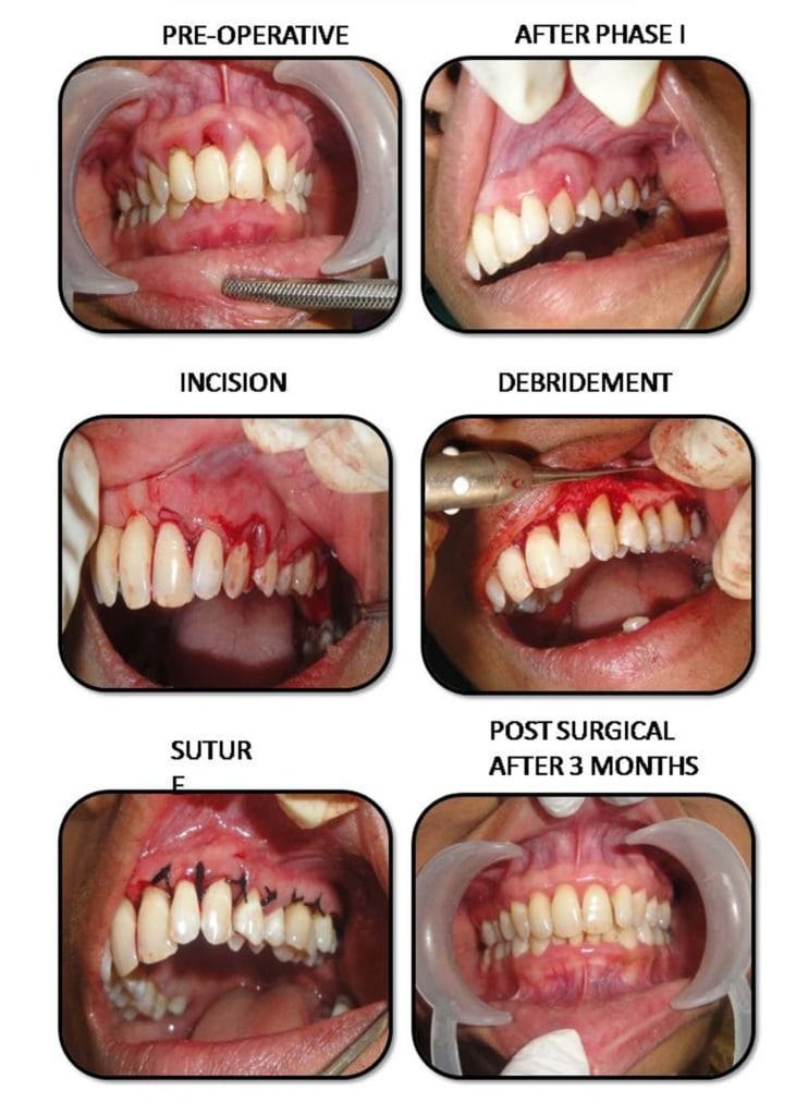 Six stages of a gum surgery case: pre-operative, after phase one, incision, debridement, suture, and three months after surgery