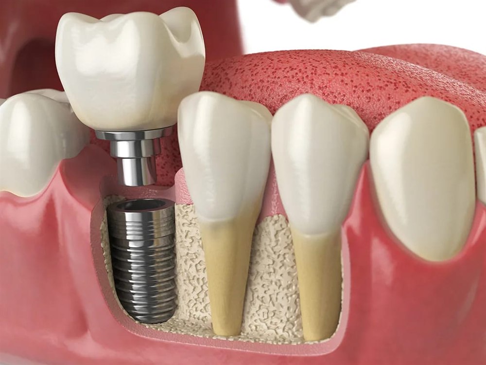 A dental implant placed in the jawbone beside natural teeth