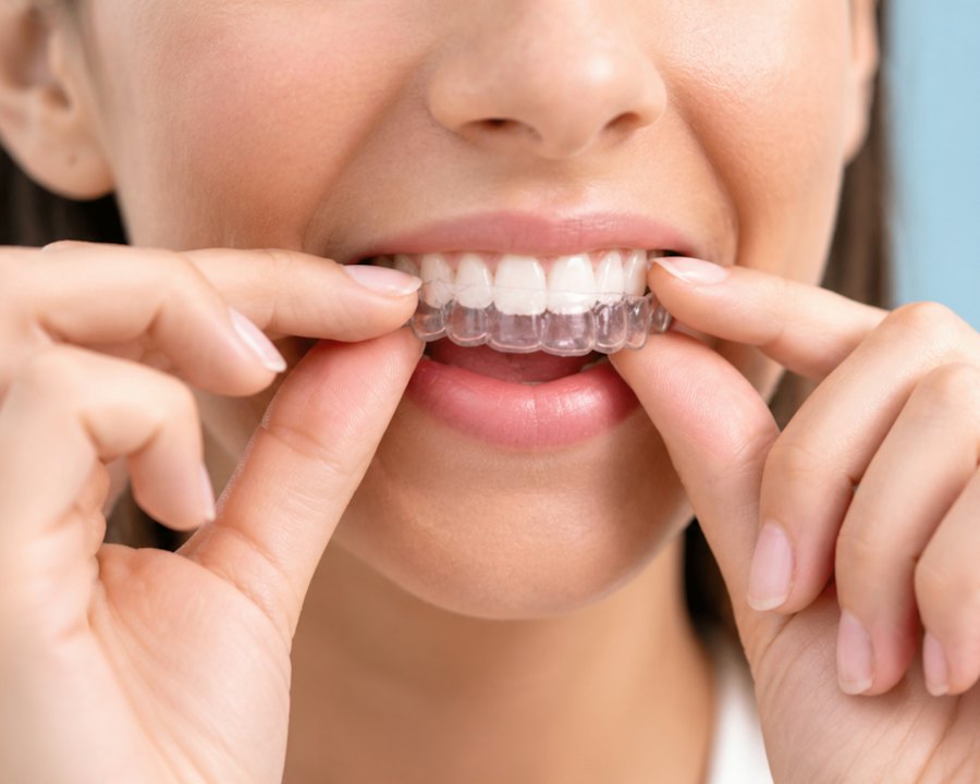 A clear removable aligner being placed over the teeth