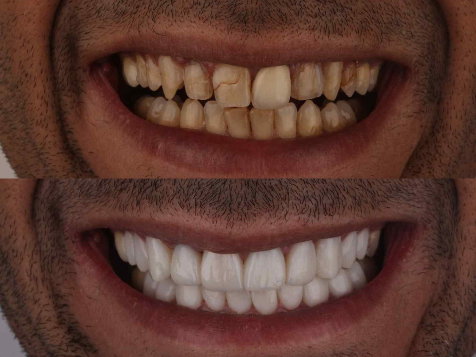A smile design case: worn, stained and uneven teeth before treatment, and the finished result afterwards